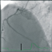 Abb. 2: Stenose - RCA