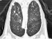 Abb. 4: Rheumapatienten im OP