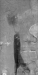 Aktuelles Bild - Abb. 1: Venses Stenting