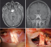 Fig. 1: Intracranial Meningioma