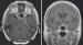 Fig. 2: Intracranial Meningioma