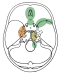 Fig. 3: Intracranial Meningioma