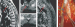This Image - Fig. 1a-e: Spinal Meningioma