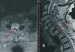 Fig. 2: Spinal Menigioma