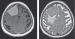 Fig. 1: Meningeoma
