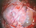 Fig. 4: Brain-Collision-Tumour