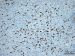 This Image - Fig. 5: Brain-Collision-Tumour