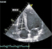 Abb. 1: Rechtsherzdilatation