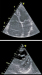 Abb. 5: Trikuspidalinsuffizienz.