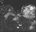Abb. 3: Mammakarzinom