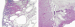 Abb. 2a-b: Krukenberg-Tumor