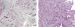 Abb. 3a-b: Magenkarzinom