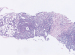 Abb. 4a: Follikulres Lymphom