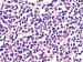 Abb. 4b: Follikulres Lymphom