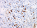 Abb. 4d: Follikulres Lymphom