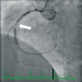 Abb. 5: In-Stent-Restenose