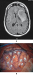 Fig. 2A-B: Awake Craniotomy