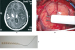 Fig. 3A-C: Awake Craniotomy