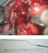 Fig. 4: Awake Craniotomy