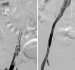 Abb. 1: Thrombose