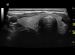Abb. 9: Video 1 - Rechter Lappen