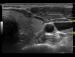 Abb. 12: Video 4 - Gesamte Schilddrse 