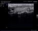 Abb. 14: Video 6 - Linker Lappen