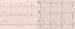 Aktuelles Bild - Abb. 1: Vorhofflattern