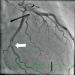 Abb. 1: Ramus circumflexus 