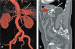 Abb. 3a-b: Sacciformes Aneurysma