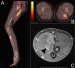 Fig. 1a-c: Mantle cell lymphoma