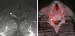 Fig. 2a-b: Primary neurolymphomatosis