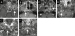 Fig. 1a-f: Skull-base metastases