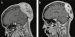Fig. 2a-b: Calvarial metastasis