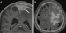 Fig. 3a-b: Calvarial metastasis