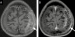 Fig. 4a-b: Calvarial metastasis