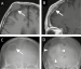 Fig. 5a-d: Calvarial metastasis