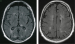 This Image - Fig. 1a-b: Brain-Lymphoma