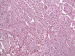 Abb. 8: Paragangliom-Harnblase