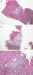 Abb. 1a-c: Transplantatabstoung