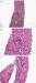 Abb. 3a-c: Hepatitis-C-Rekurrenz