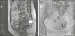 Abb. 2a-b: Uterus myomatosus 