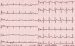 Aktuelles Bild - Abb. 1: Hypokalimie