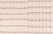 Abb. 2: T-Wellen-Morphologie