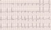 Aktuelles Bild - Abb. 1: EKG