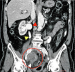 Abb. 3: Iliakalaneurysma