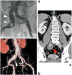 Abb. 5: Iliakalaneurysma
