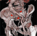 Abb. 7: A. iliaca communis und interna