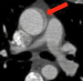 Abb. 1: Aorta ascendens