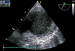Aktuelles Bild - Abb. 3: Aorta thoracica